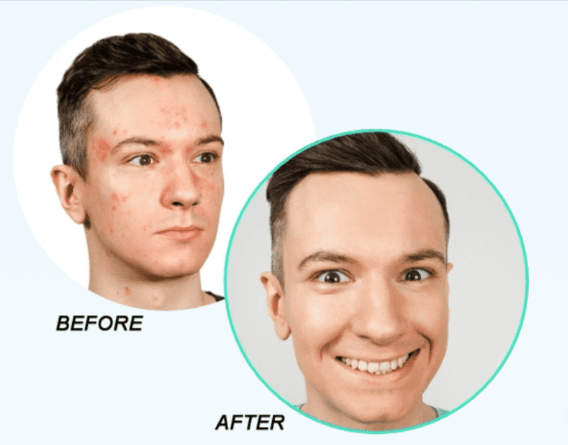 revamin acne crème werkt, effecti